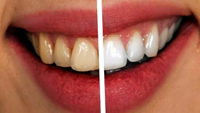 Before and after comparison of fluoride-free bamboo charcoal teeth whitening with a close-up of lips.